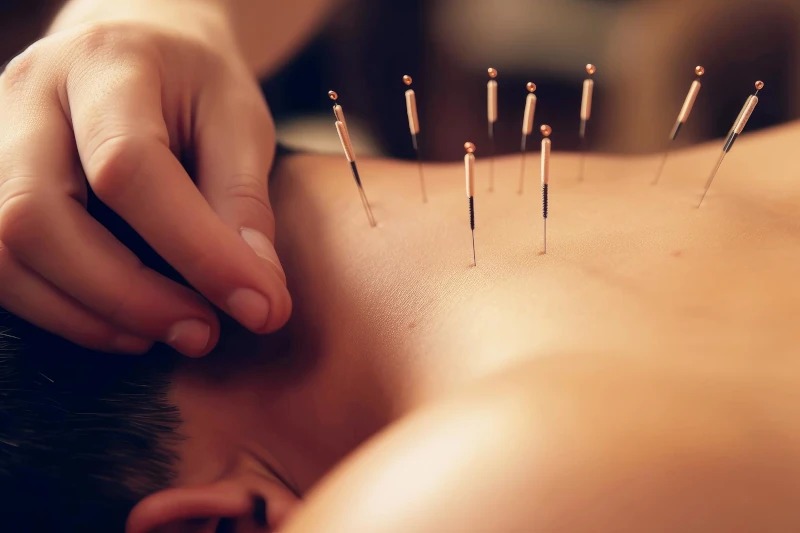 طب سوزنی چیست و چه معایب و مزایایی دارد